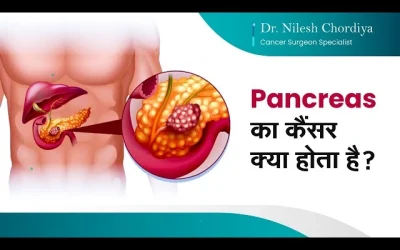 What is Pancreas Cancer?