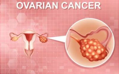 Screening for Ovarian Cancer