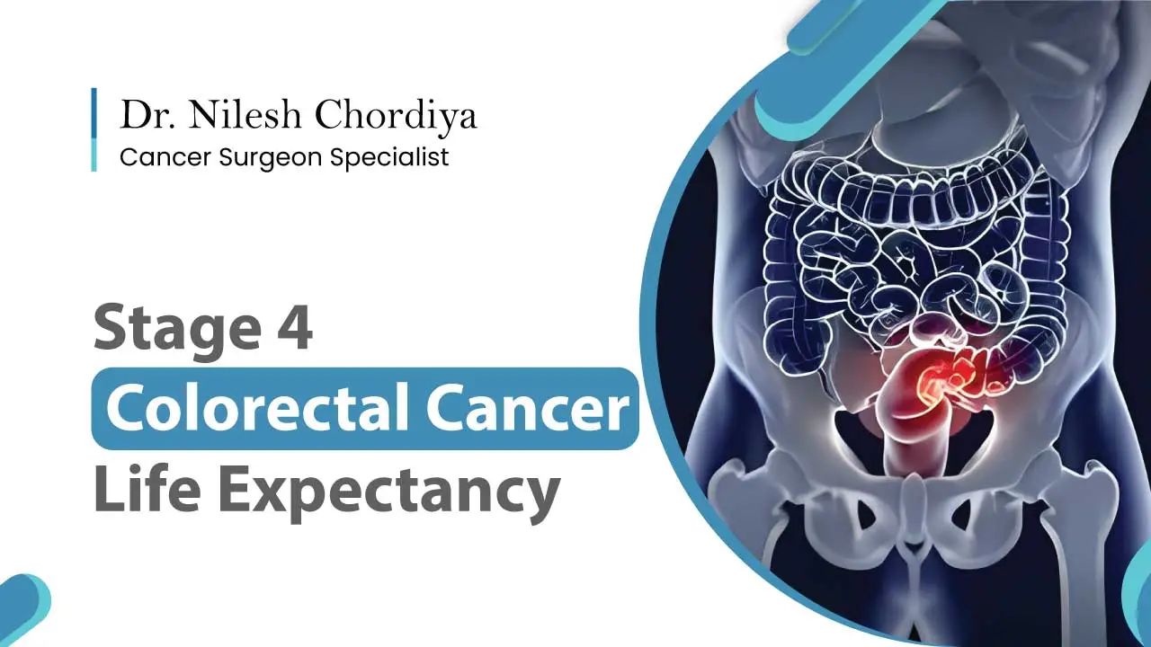 Stage 4 Colorectal Cancer Life Expectancy