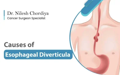Unveiling the Causes of Esophageal Diverticulum